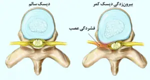 چرا دیسک کمر در جوانان بیشتر از گذشته دیده میشود؟ 4 دیسک کمر در جوانان